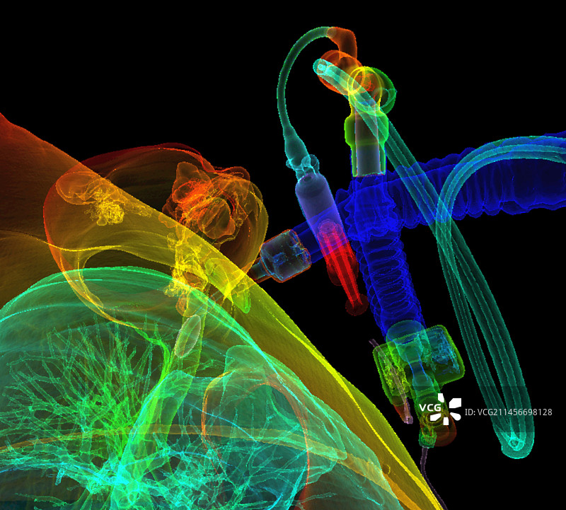 接受气管切开术和使用呼吸机的病人，3D CT扫描图片素材