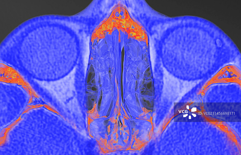 鼻旁窦，3D CT扫描图片素材