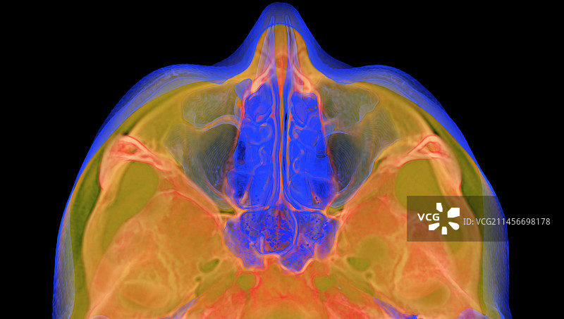 鼻旁窦，3D CT扫描图片素材