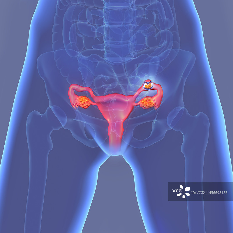 异位妊娠插图图片素材