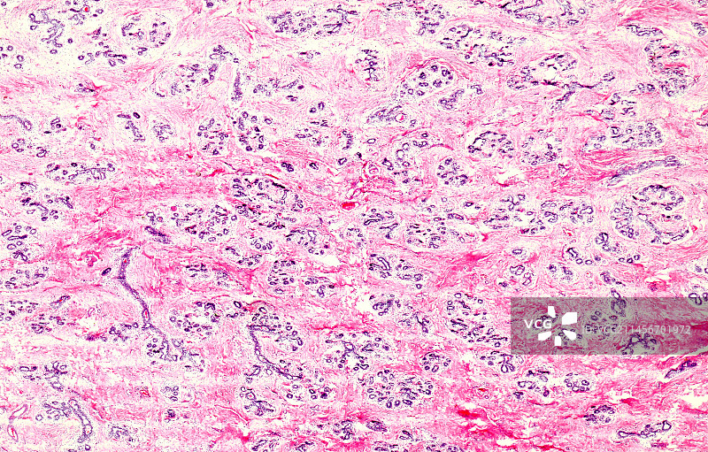 慢性乳腺炎浅显显微照片图片素材