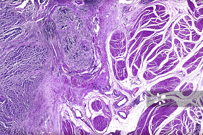 膀胱移行细胞癌，光学显微照片图片素材