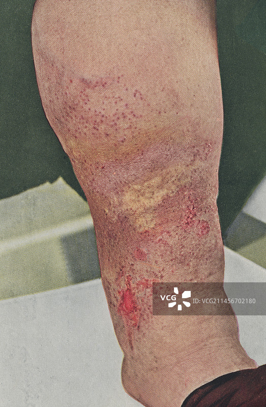 静脉曲张性湿疹历史图片图片素材