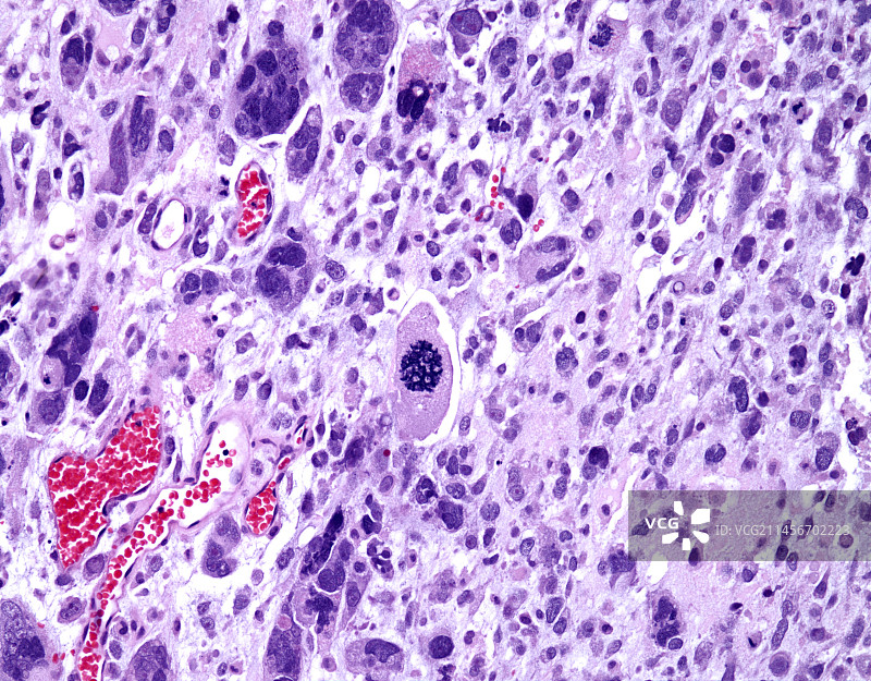 多形性横纹肌肉瘤，光镜照片图片素材