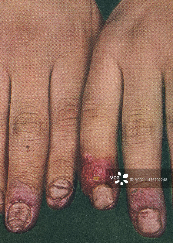 甲沟炎历史图像图片素材