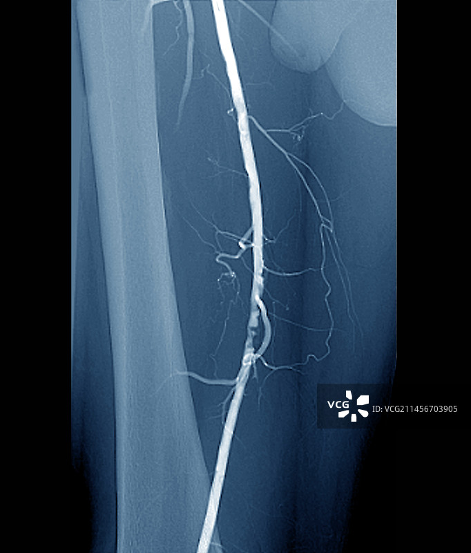 腿部动脉狭窄血管造影图片素材