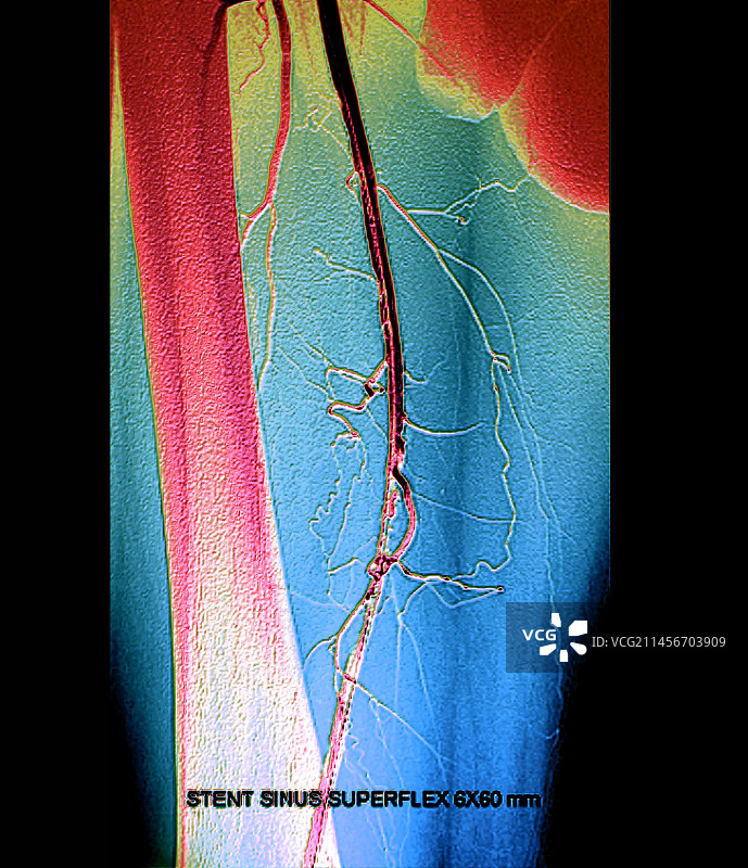 腿部动脉血管成形术，血管造影图片素材