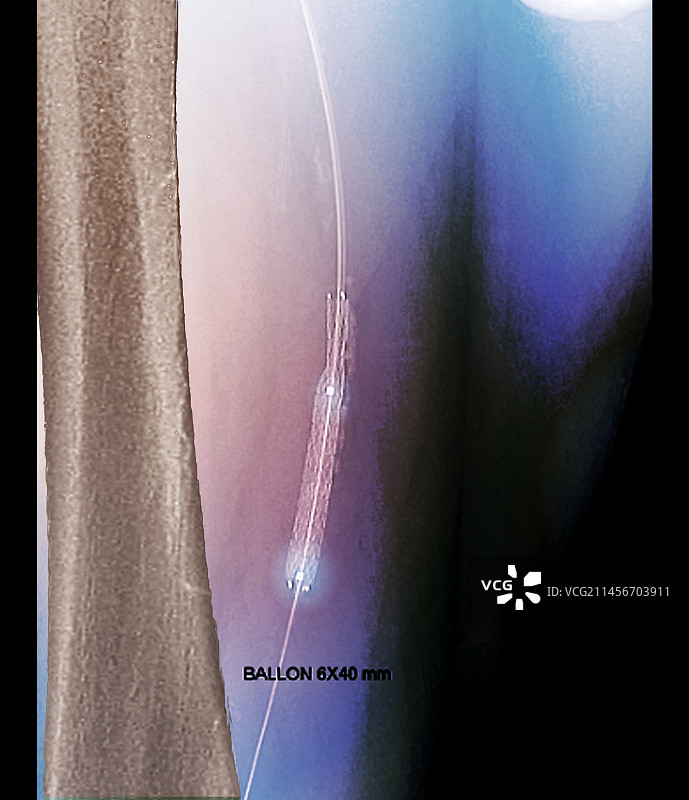 腿部动脉血管成形术，血管造影图片素材