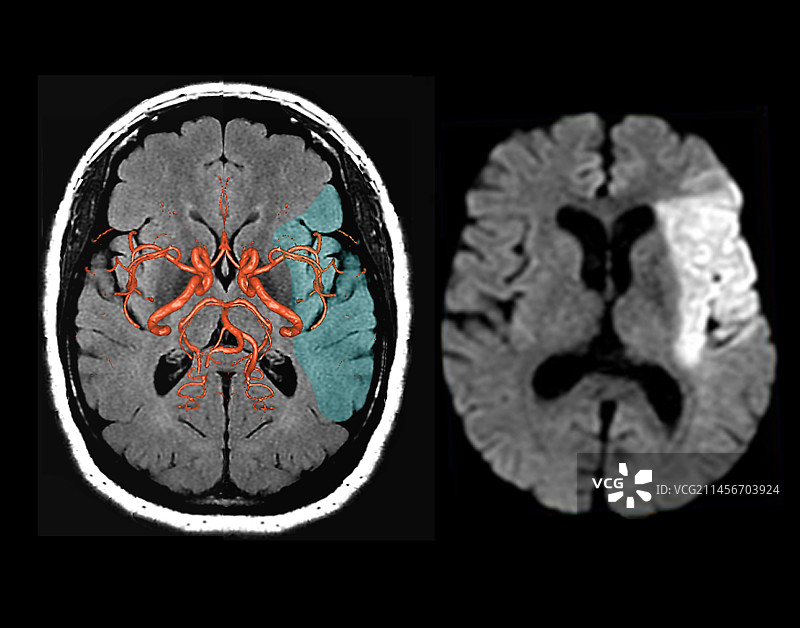 中风核磁共振扫描图片素材