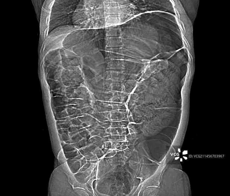 奥格尔维综合征CT扫描图片素材