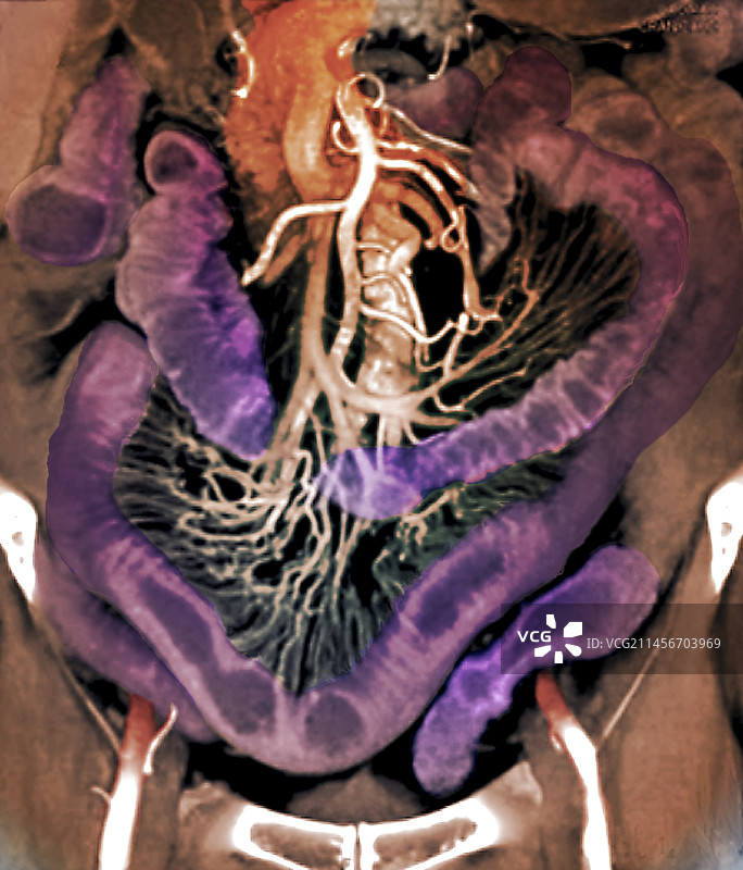 腹部解剖结构CT扫描图片素材