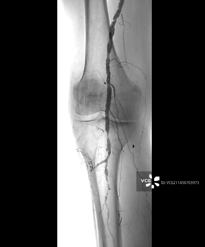 动脉粥样硬化，X光片图片素材