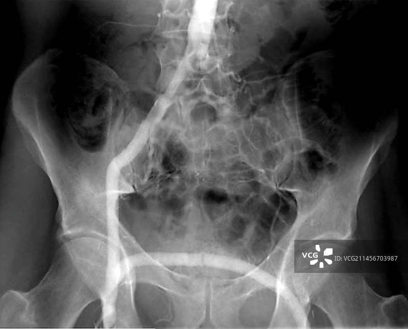 动脉搭桥血管造影图片素材