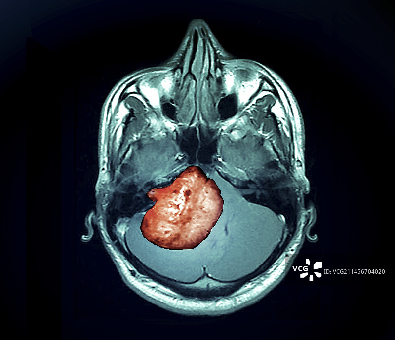 听神经瘤肿瘤MRI扫描图片素材