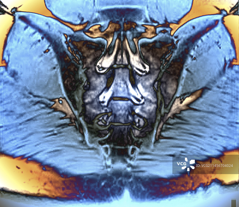 骶骨核磁共振扫描图片素材