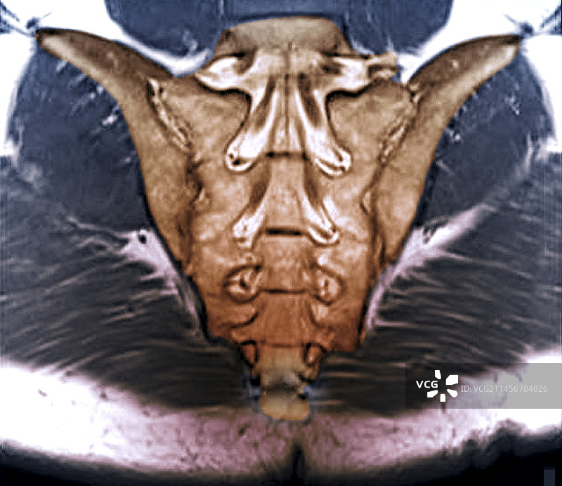 骶骨核磁共振扫描图片素材