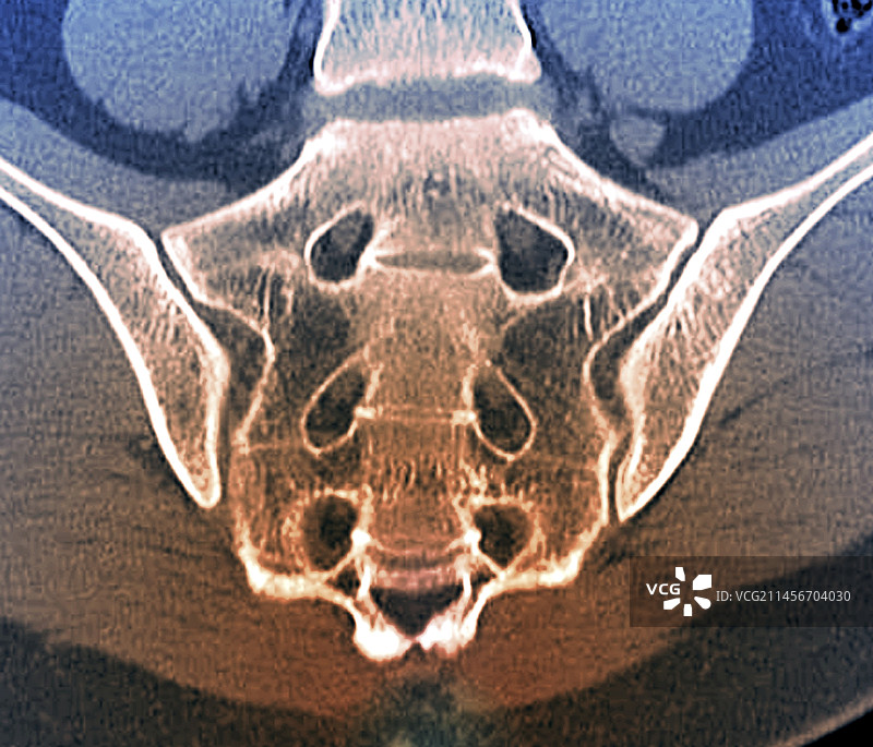 骶骨CT扫描图片素材