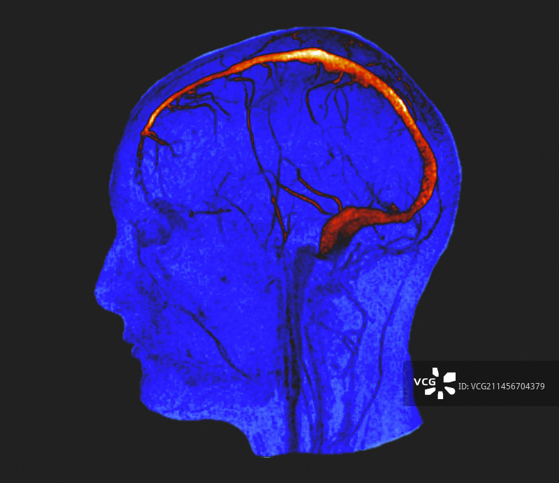 脑静脉和静脉窦核磁共振血管造影图片素材