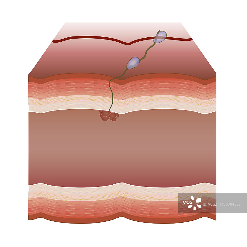 肿瘤图示图片素材