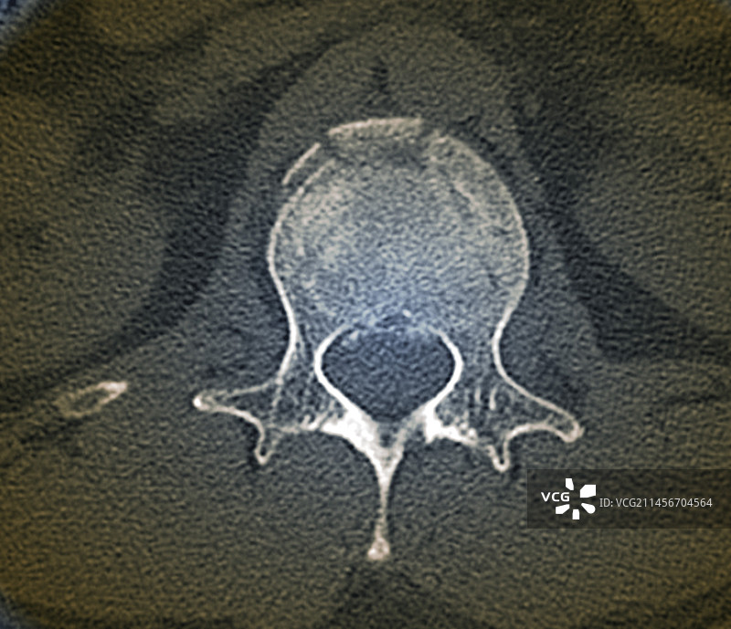 腰椎骨折CT扫描图片素材