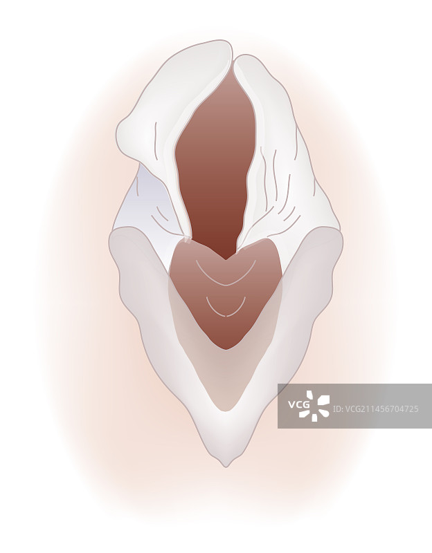 声带麻痹插图图片素材