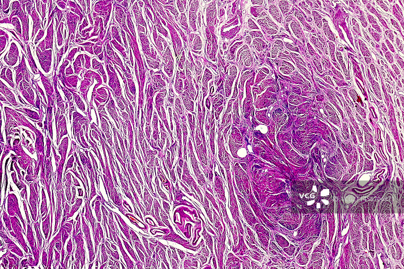 人宫颈外翻，光学显微照片图片素材