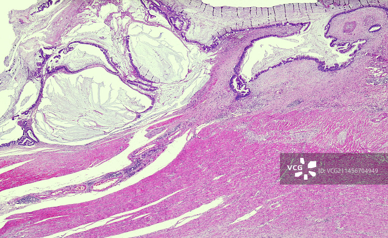 绒毛结肠腺癌，光学显微照片图片素材