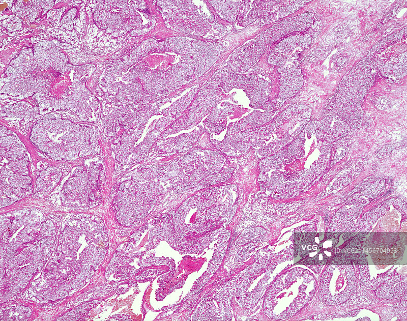 人类肾细胞癌显微照片图片素材