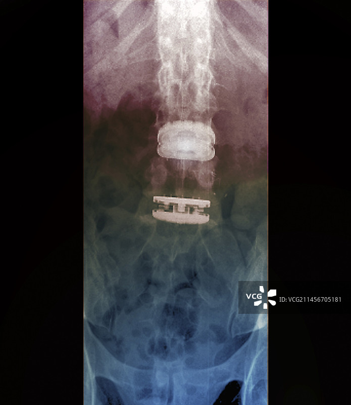 椎间盘植入物X光片图片素材