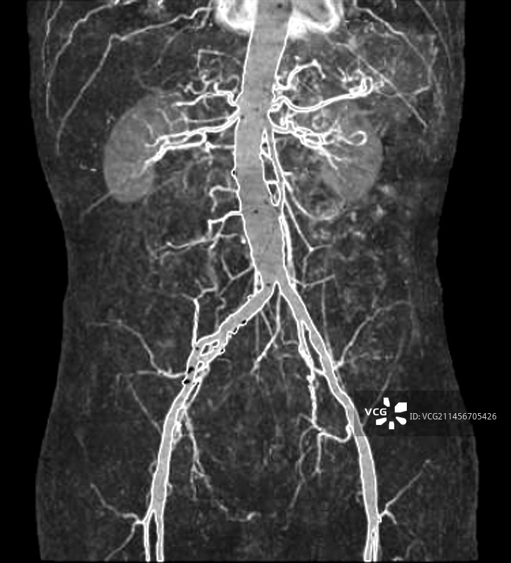 扩张的腹主动脉，CT扫描图片素材