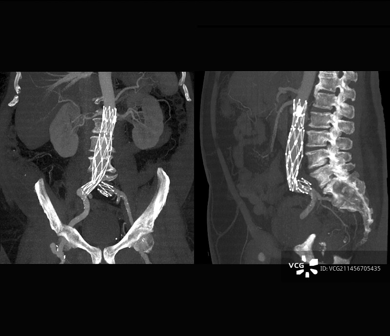 主动脉瘤支架CT扫描图片素材