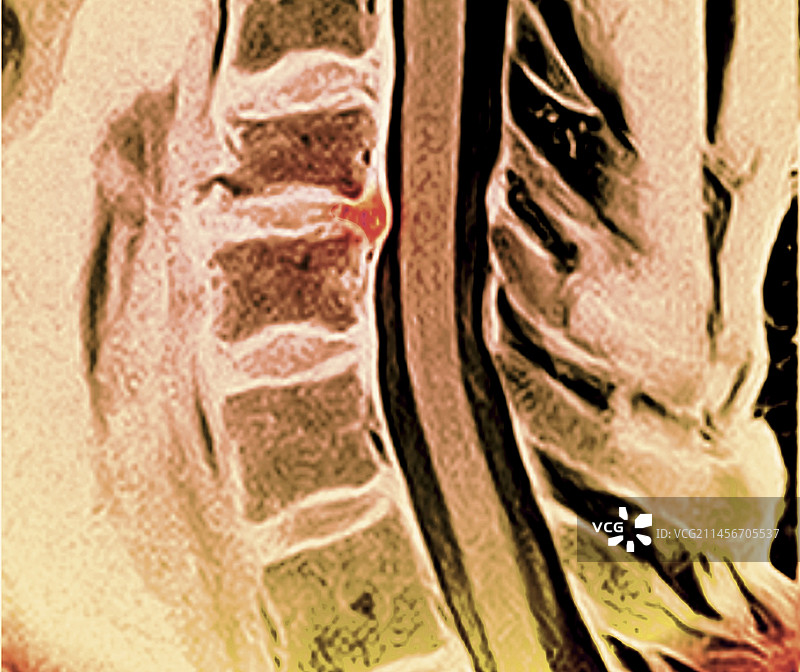 椎间盘突出核磁共振扫描图片素材