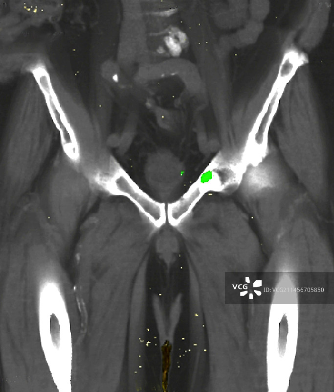 继发性骨癌PET扫描图片素材