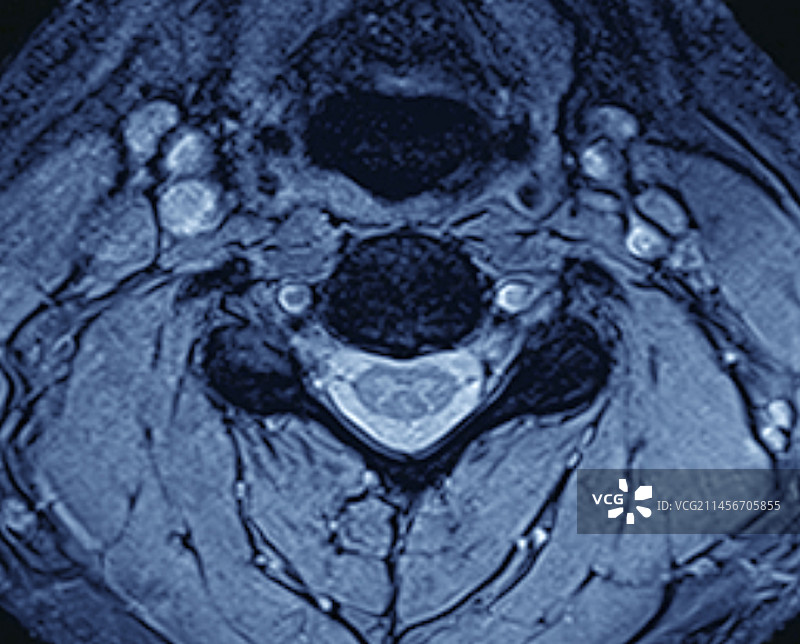 脊椎和脊髓MRI扫描图片素材