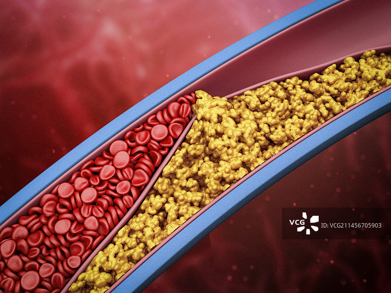 动脉狭窄插图图片素材