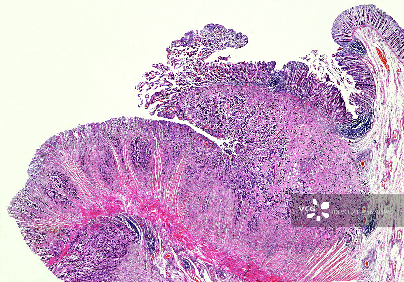 肠腺癌光镜照片图片素材
