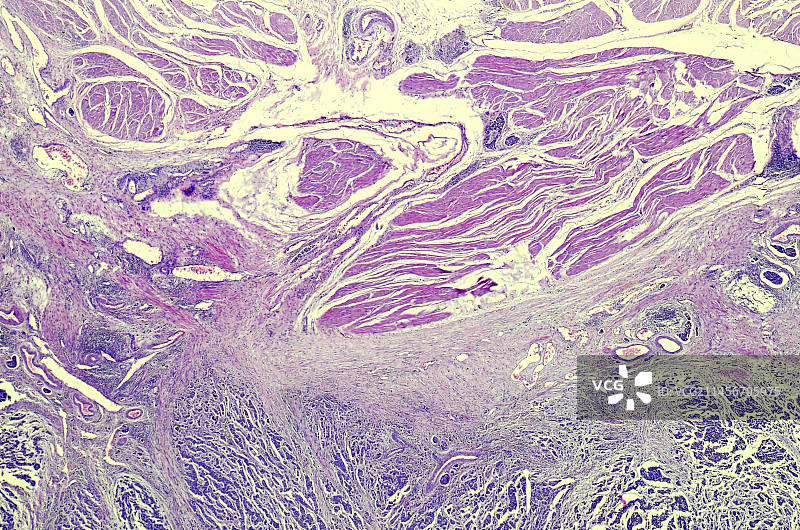 膀胱癌显微照片图片素材