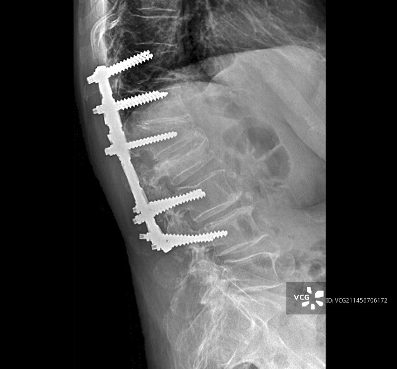 脊柱骨质疏松症的X光治疗图片素材