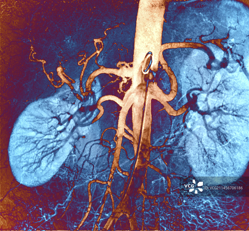肾脏血管血管造影图片素材