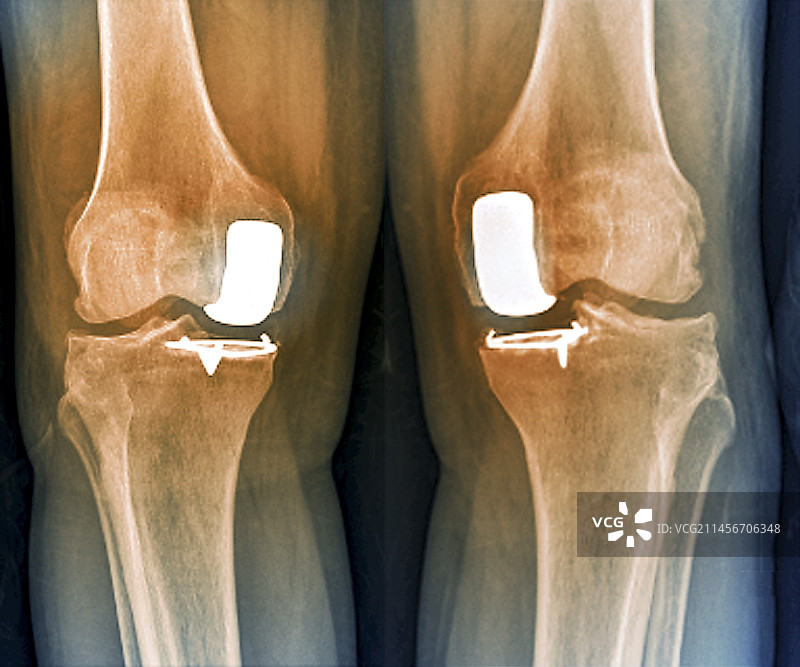 部分膝关节置换X光片图片素材