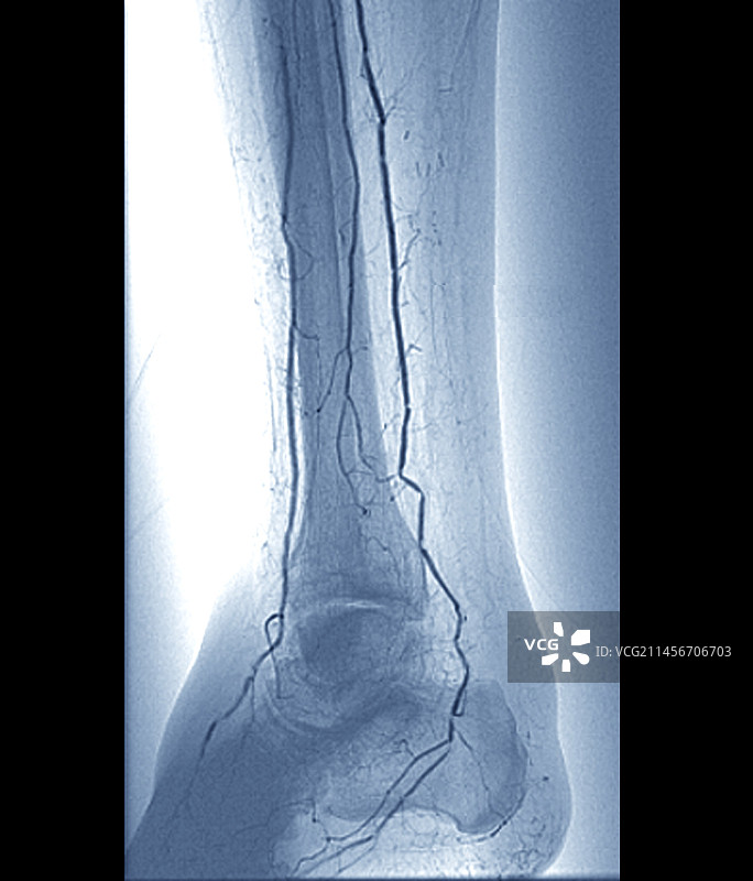 腿部动脉狭窄X光片图片素材