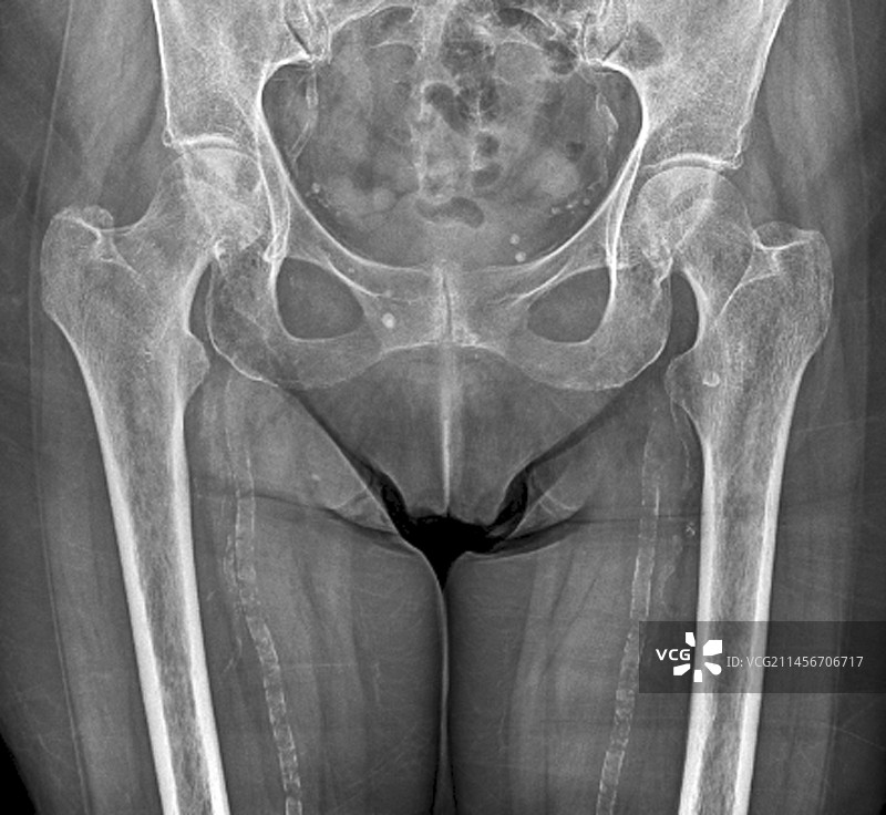 动脉粥样硬化，X光片图片素材