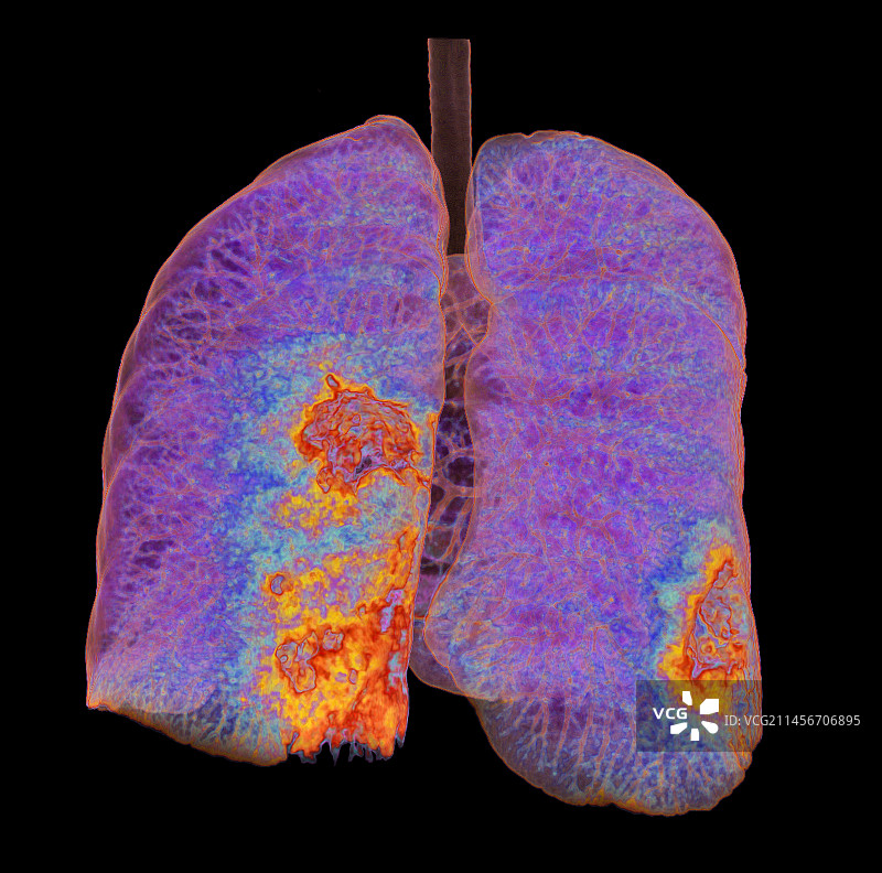 受新冠影响的肺部非典型肺炎3D CT扫描图片素材