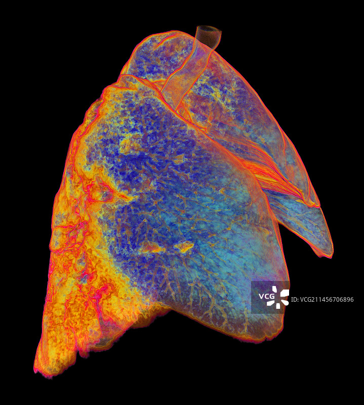 受新冠影响的肺部非典型肺炎3D CT扫描图片素材