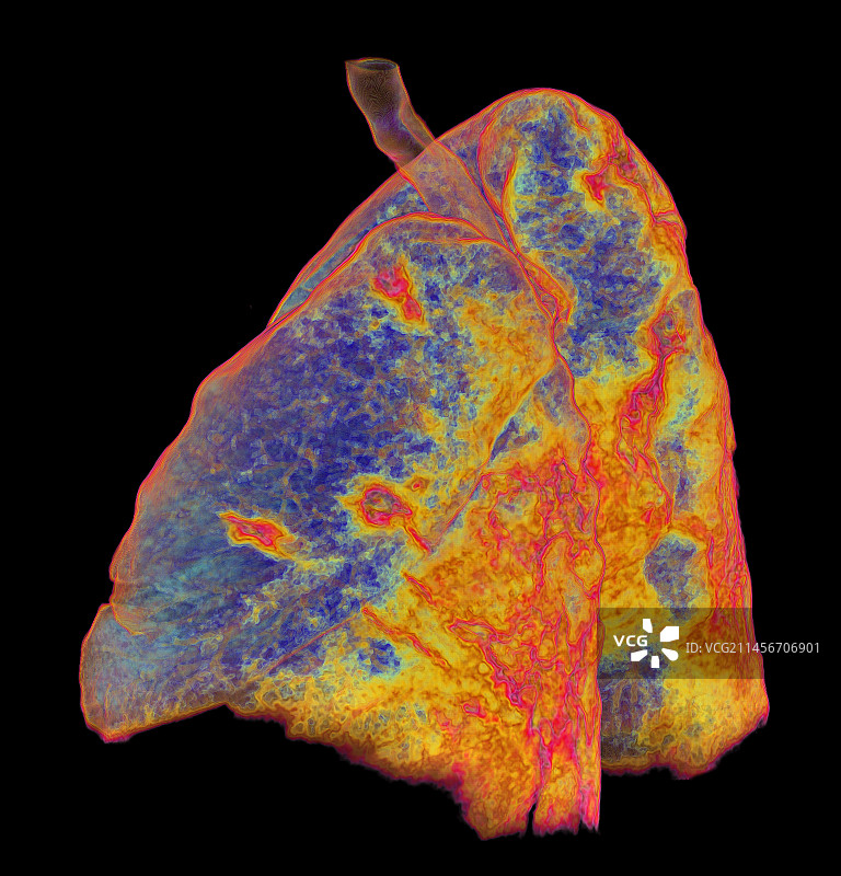 受新冠影响的肺部非典型肺炎3D CT扫描图片素材