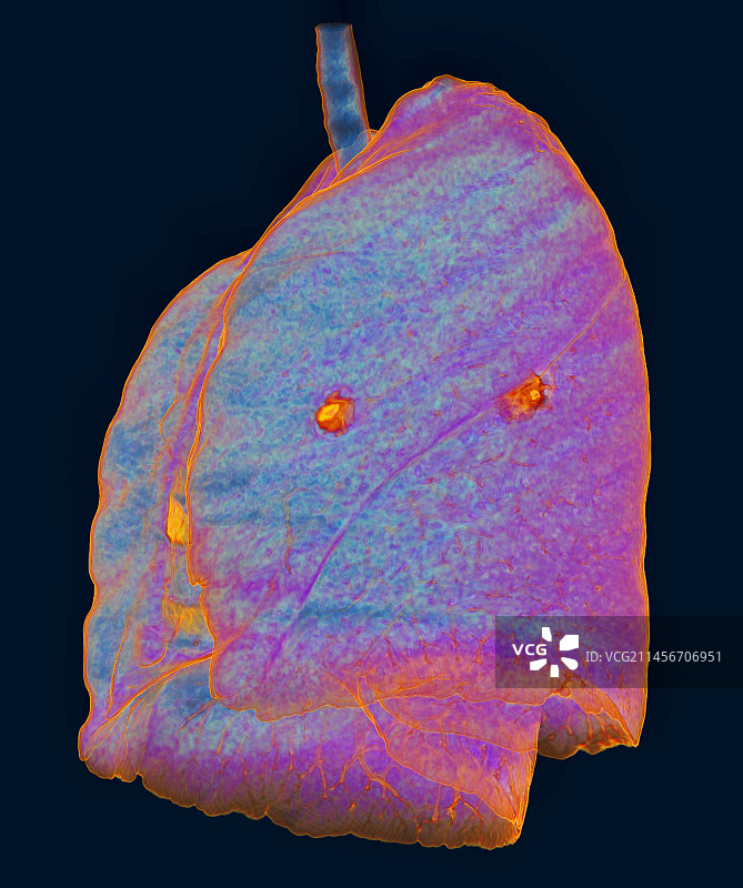 受新冠影响的肺部非典型肺炎3D CT扫描图片素材