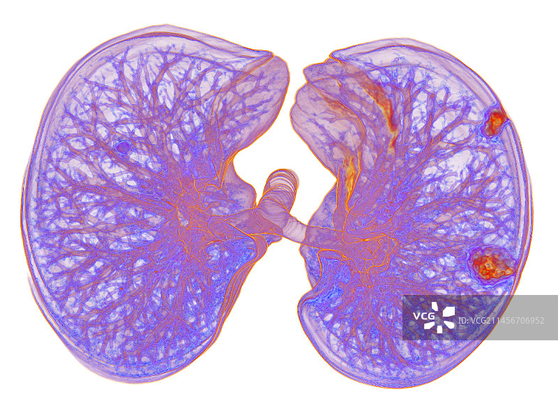 受新冠影响的肺部非典型肺炎3D CT扫描图片素材