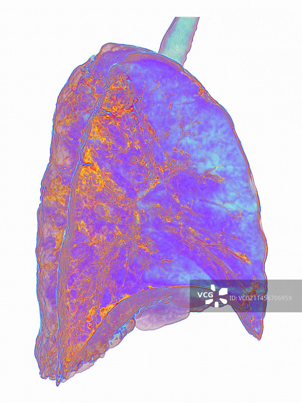 受新冠影响的肺部非典型肺炎3D CT扫描图片素材