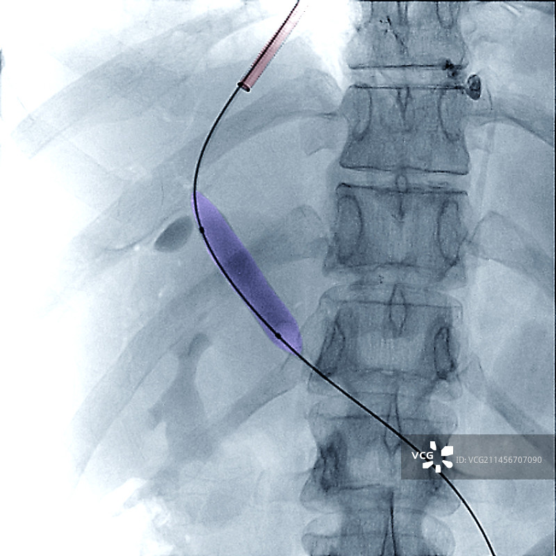 门静脉手术X光片图片素材
