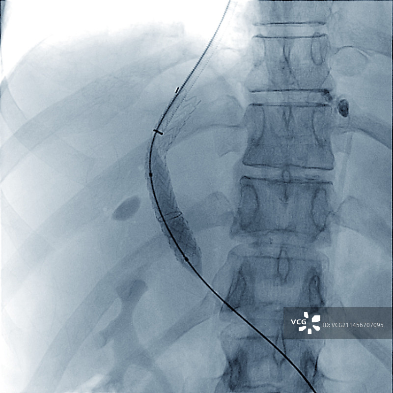 门静脉手术X光片图片素材